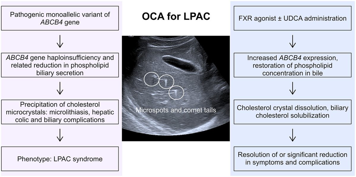 APandT's tweet photo. Obeticholic acid as a second-line treatment for low phospholipid-associated cholelithiasis syndrome - read at https://t.co/UuodKySplL
#livertwitter  #UDCA #LPAC #OCA https://t.co/W6V7Mnx4MP