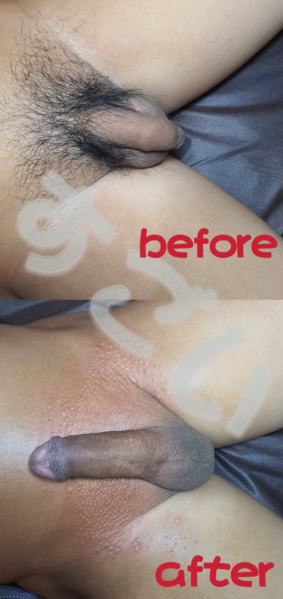 客人小逸是一名廚師，在廚房環境很悶熱下體總是很癢，於是選擇巴西式全除，除完之後看起更粗大了呢！

立馬預約:lin.ee/J2faxaD