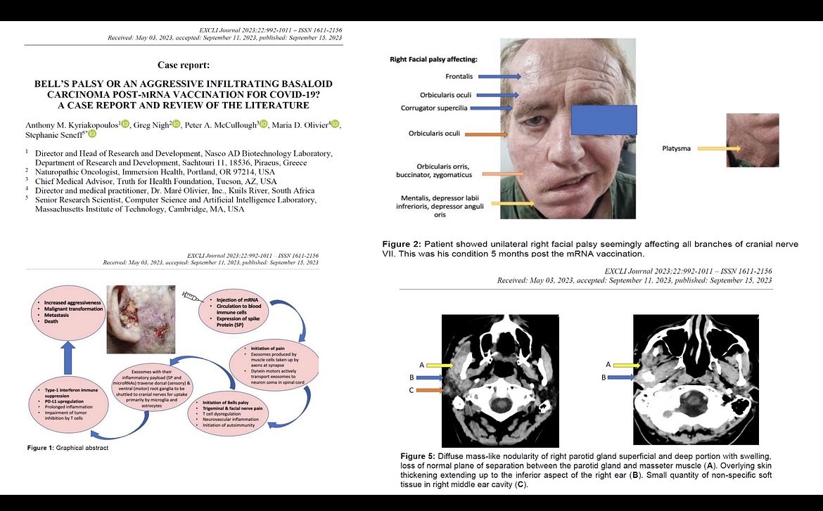 P_McCulloughMD's tweet photo. @robinmonotti @parelladori We published this case of fatal COVID-19 vaccine induced cancer in the peer reviewed literature.  Serves as an example of horrific, invasive “turbo cancer.”  https://t.co/WH6KCKWtvZ https://t.co/tPSwn89t8a