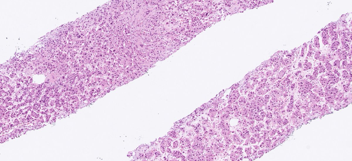 DrJuhlin's tweet photo. Recent case. Young female patient with 70 mm unilateral adrenal mass. Hormonal workup is negative. Suspected mets to liver and lung. Core needle biopsy of liver mass. Some teaching points are provided below: https://t.co/2rfPj5UpzG