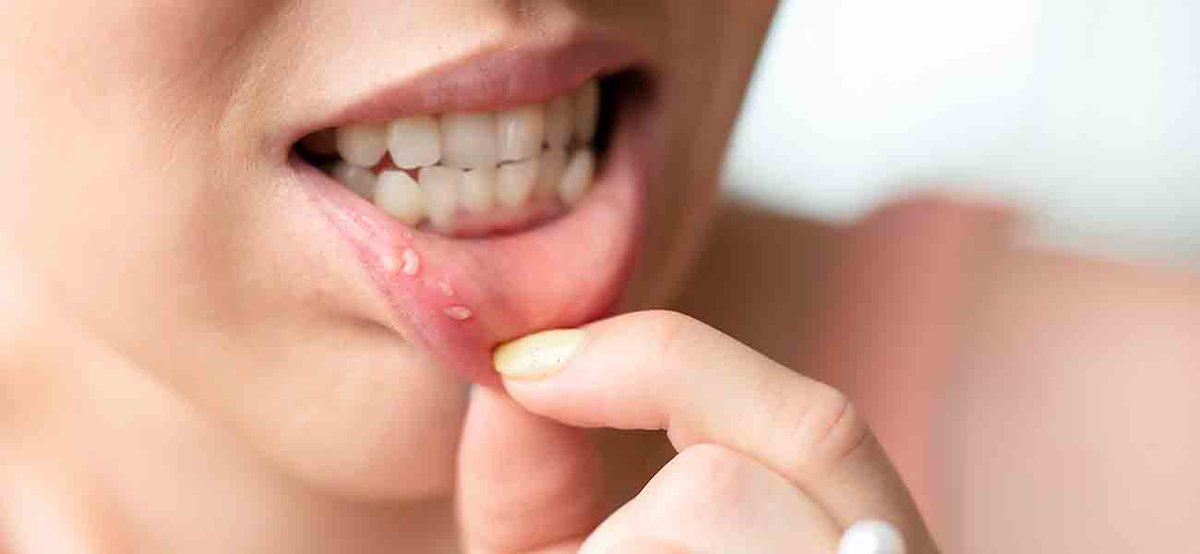 Dil ve ağız yaraları neden olur? Nasıl tedavi edilir haberxr.com/dil-ve-agiz-ya…