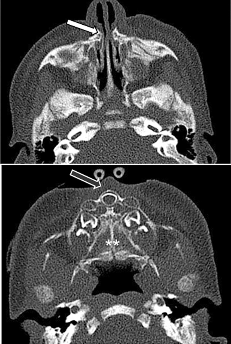 From the April-June 2023 Issue of #Neurographics: Developmental Anomalies of the Midface ow.ly/LgBL50PaEQj