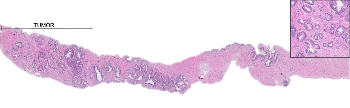 katcollmd's tweet photo. 🔬 Post-treatment biopsies with residual adenocarcinoma located outside the treatment zone. #gupath #HIFU #prostatepath https://t.co/Pa5CEuddBS