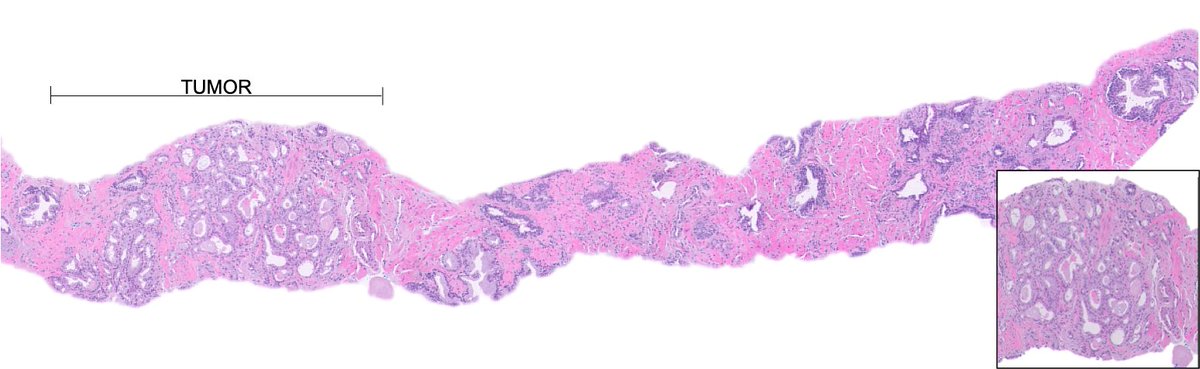 katcollmd's tweet photo. 🔬 Post-treatment biopsies with residual adenocarcinoma located outside the treatment zone. #gupath #HIFU #prostatepath https://t.co/Pa5CEuddBS
