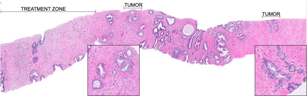 katcollmd's tweet photo. 🔬 Post-treatment biopsies show well-demarcated interface between treated and untreated areas.
#gupath #HIFU #prostatepath https://t.co/kCRvZpvzWd