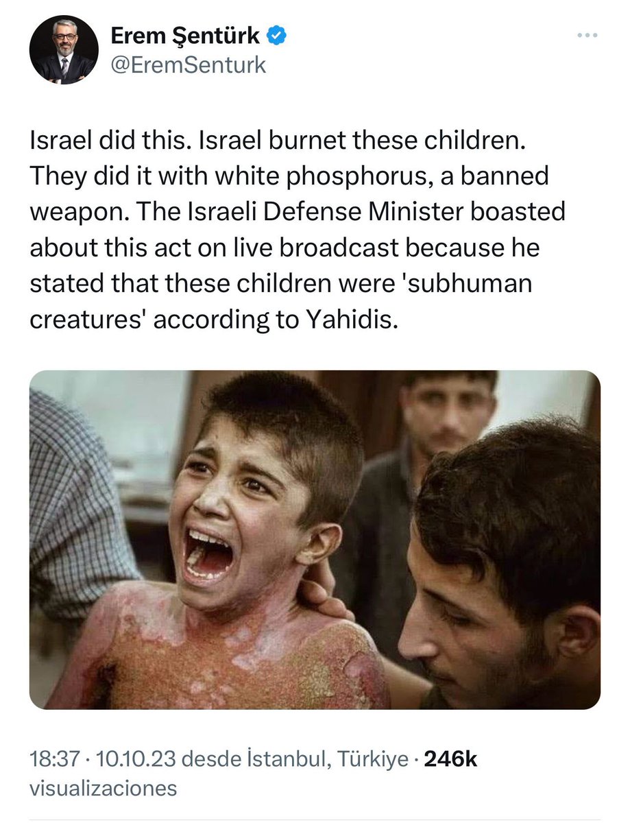 Mustafa_Alali2's tweet photo. “My name is Mohammed Hameed Mohammed, I was burned with white phosphorus used by Turkey in its attack on #serekaniye in 2019, I am not from Palestine, I am from #Serekaniye,I was not attacked by Israel, but by Erdogan,I live now in Serekaniye camp” https://t.co/wV0tCgcsLe
