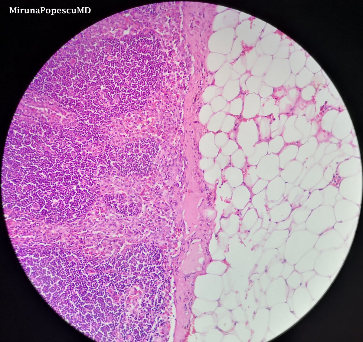 MirunaPopescu13's tweet photo. #pathbasics 📚 #PGY1
When assessing for the presence of lymph node metastases, be sure to not confuse sinus histiocytes (1st pic) with true invasive tumor cells (2nd pic 👉🏽 in this case: LN met of an invasive urothelial carcinoma).
#PathTwitter #PathX #pathresidents #GUPath https://t.co/wKsTaY0GHl