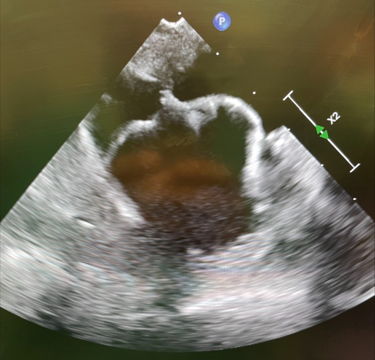 The WATCHMAN FLX™ Pro 40mm device helps treat a wider range of pts. by closing larger appendages that were untreatable or challenging to close with a 35mm device - Great 1st implant in an anterior chicken wing anatomy by Dr. Brad Mikaelian at @UCHealth Memorial Hospital Central!
