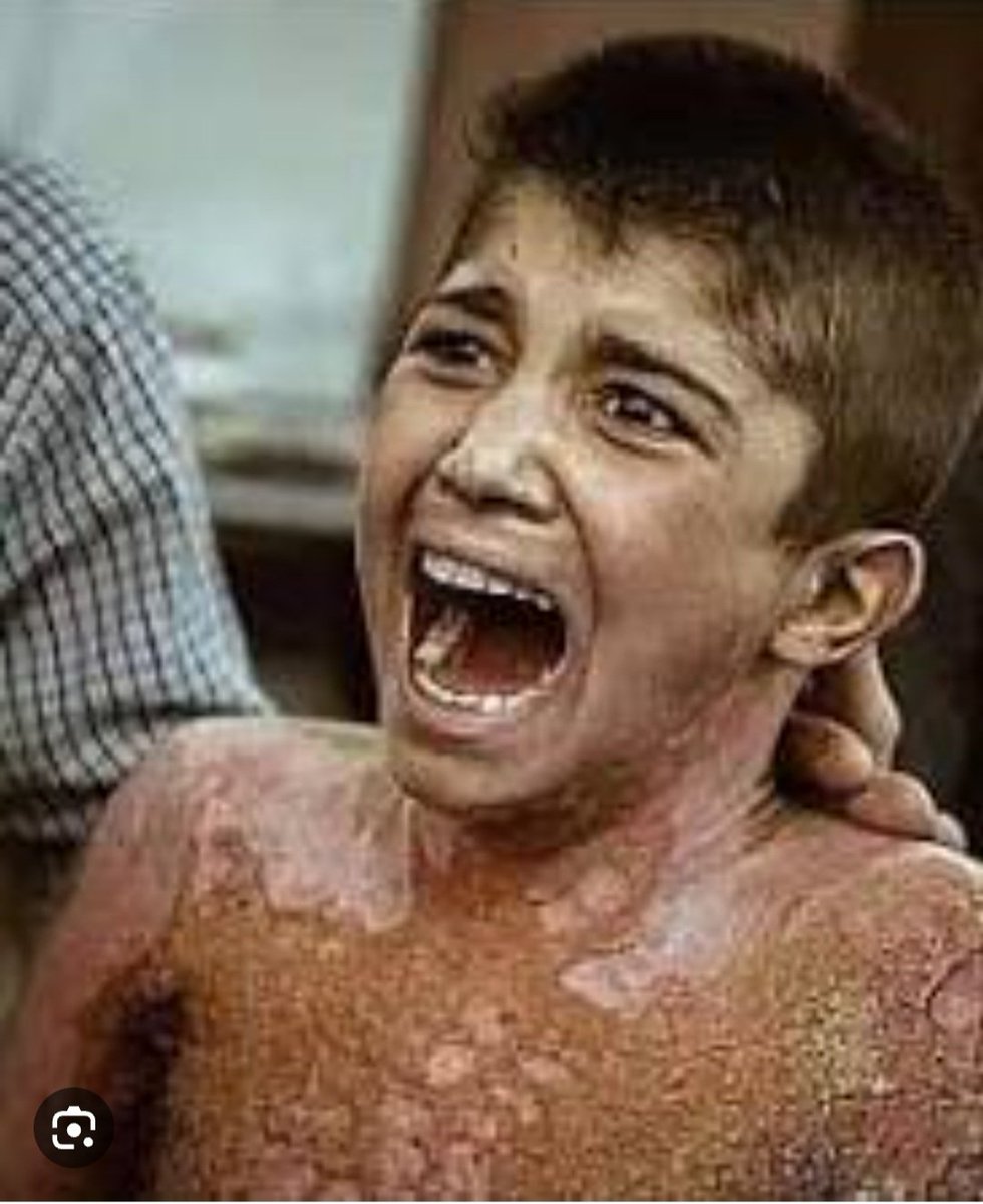 Hussein05633026's tweet photo. المئات من الإعلاميين والسياسيين الترك نشروا هذه الصورة على أنه طفل فلسطيني حرق الفوسفور الإسرائيلي جسده وذرفوا دموع التماسيح الإنسانية والدينية، ولكن حينما افتضح أمرهم وعلموا أن الصورة للكردي محمد  الذي حرق فوسفور قنابلهم جسده في سري كانيه، أزالوا الصورة ومسحوا دموعهم وسكتوا. https://t.co/MsIsWEUETW