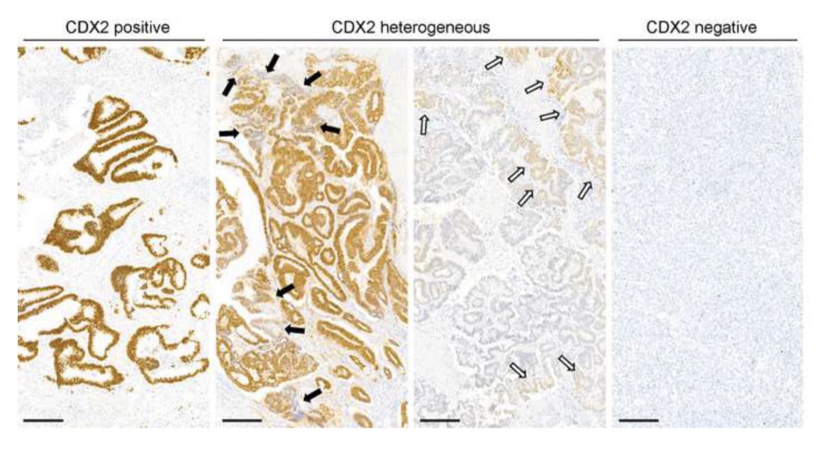 💥Just OUT: the role of CDX2 loss in CRC 🧫. 🤝A collaborative effort with @CalonLab 📌 Is the current classification of CDX2 loss appropriate? 📌 Will be possible to reverse CDX2 loss and improve patients’ prognosis? Work supported by @fundacionmutua cancertreatmentreviews.com/article/S0305-…