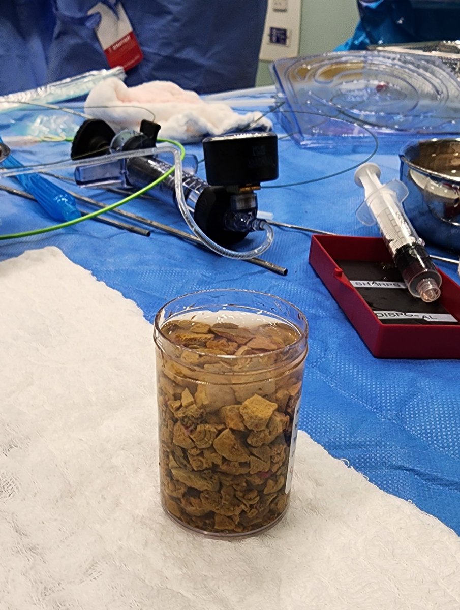 AliAbdelRaheem9's tweet photo. Sometimes you need to TURP the stone 😀.
#endourology #urinarystone #PCNL #MIS #ASU #AAU
@King Saud Medical City @مدينة الملك سعود الطبية https://t.co/KFuAUqt134