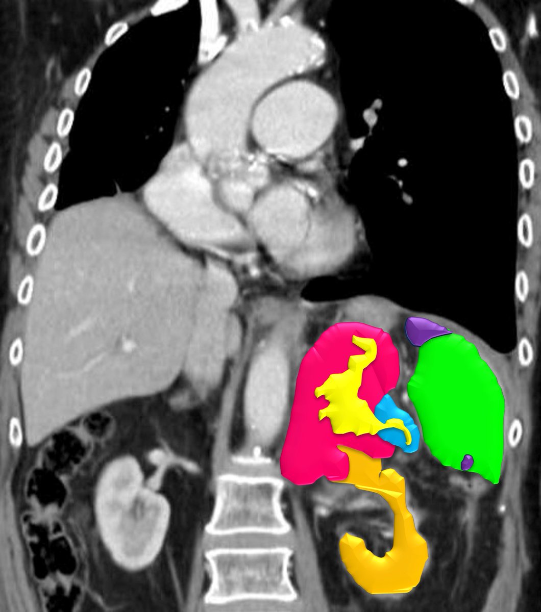 Rare complication of adrenal met from lung adenocarcinoma 🫁 It perforated the splenic flexure 🔵, drained its necrotic content into the colonic lumen and was filled with air bubbles🟡 Also spleen infarcts 🟣 due to splenic vein infiltration #radiology #radtwitter