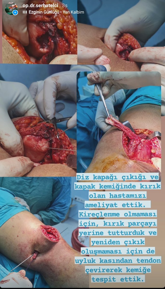 virlfumgovs's tweet photo. Diz kapağı çıkığı bağ onarımı yapılmadığı takdirde tekrarlayabilir ve kıkırdak kırıkların, kireçlenmeye yol açabilir.
#ortopedi #diyarbakır #mardin #dizkapağıçıkığı #meniskus #çaprazbag https://t.co/A1HfH8jHlZ