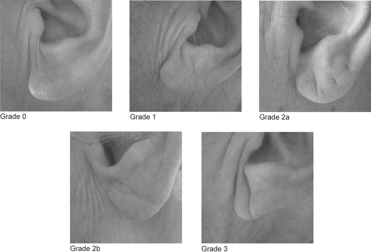 TSM_Humanist's tweet photo. ▶️Diagonal Ear Lobe Crease #DELC or #Frank_Sign, grade 3.
▶️It extends backwards from tragus at an angle of 45 degree across the lobule to the ear edge of the auricle.
4 grades, 0, 1, 2a & 2b & 3.
Indicates atheroscleroses driven ageing.
#DELC is an independent indicator of #CAD https://t.co/UChVPaVtej