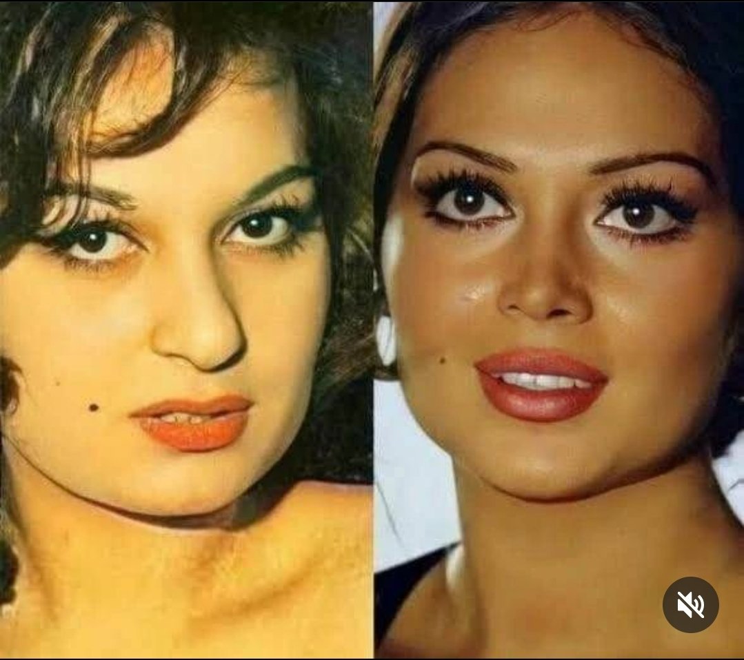 Eskiden estetik doktorları uzmanları gerçekten harika işler ortaya çıkarıyormuş👏👏 Şu anda hepsi fabrika basımı gibi🤩 şişik dudaklar💋 çekik gözler🙀 Çökük Yanaklar, Keskin jawline yüz hatları🧠 tamamen yapma yüzler