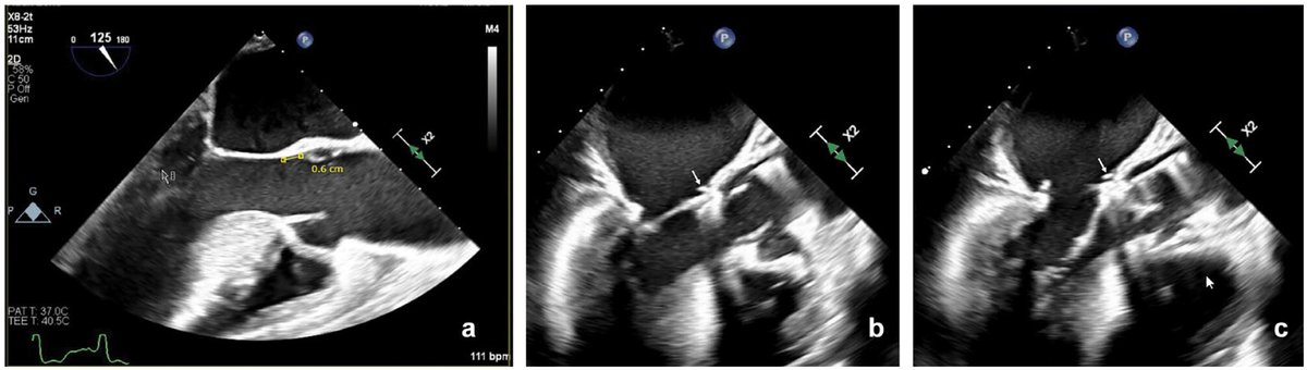 2⃣nd article in our Focused Topic Series on rapid deployment valves by Drs @SalmanZaheerMD @MichaelRobich and Reed Quinn from @hopkinssurgery includes their 7 Pillars for Perceval implantation combined with mitral valve repair or replacement Read free: doi.org/10.1177/155698…