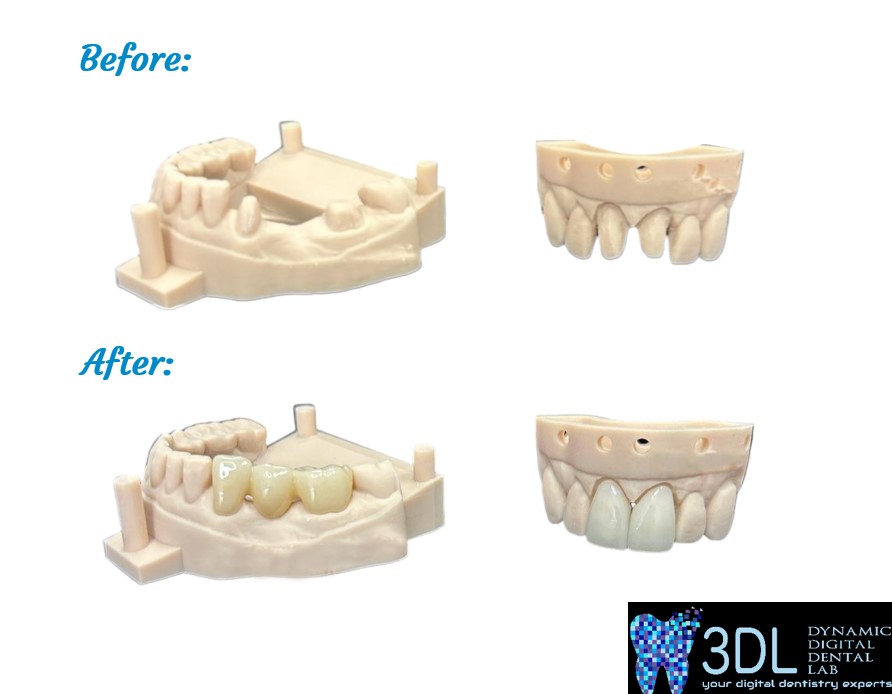dynamicdigident's tweet image. Puck drop tonight, and we&apos;re dropping some amazing dental work too! Let&apos;s make your smile a winner. 🏒🦷 #3DL #DigitalDentalLab