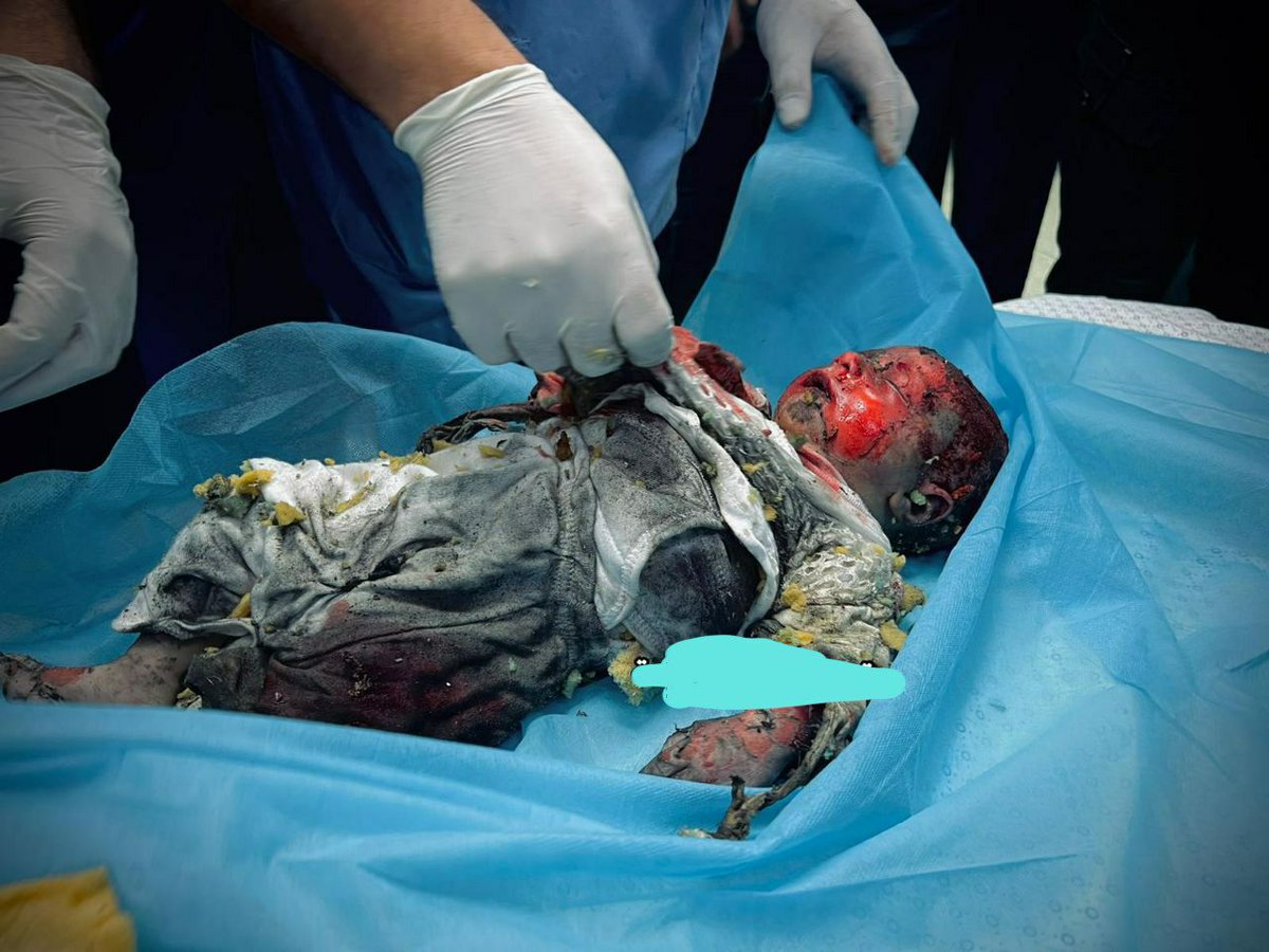 شاركوا فضلاً فضلاً وليس أمراً 
جرائم الاحتلال الصهيوني ضد الأطفال الرضع حيث أصبحوا هدفاً للطائرات الحربية والقنابل الفسفورية والعنقودية أمام أعين العالم والصمت الدولي
#غزة_الآن