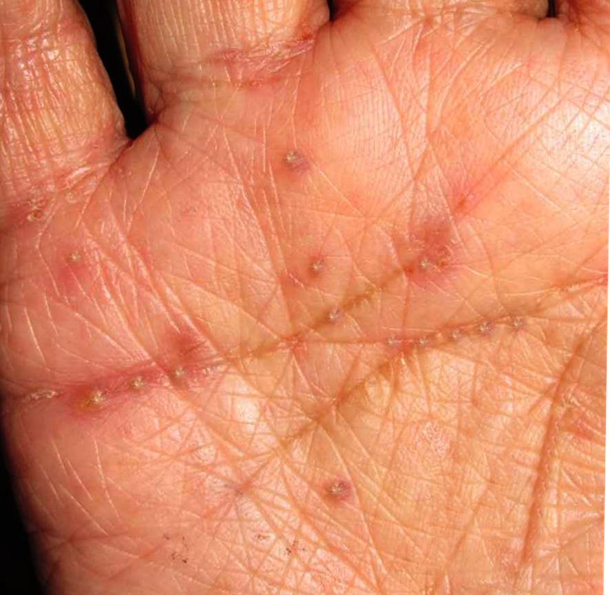 guerreroespejo's tweet photo. Varón de edad avanzada con prurito intenso en la palma de la mano desde hace diez días.
¿Diagnóstico?
1/2

#MedTwitter #residente #medicina https://t.co/nBo2SWZgxs