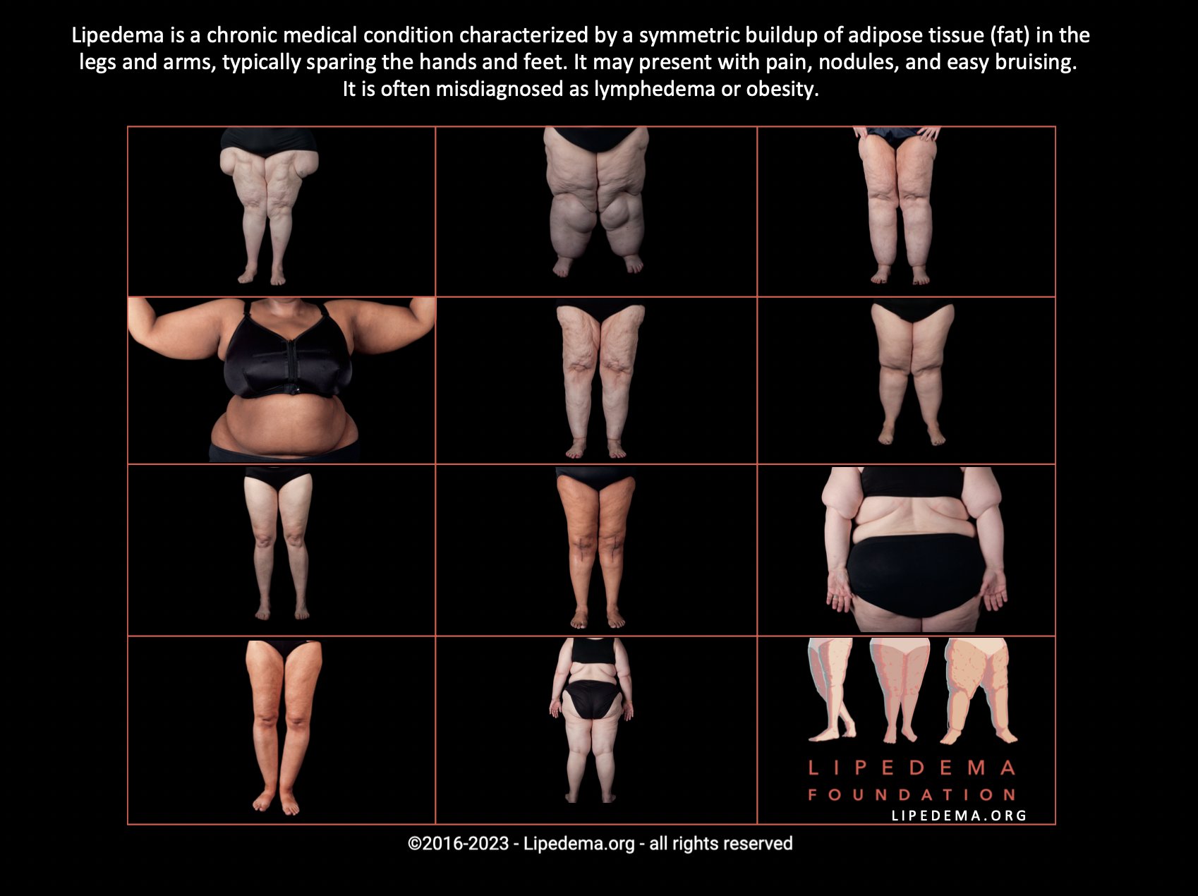 Lipedema Foundation on X: Did you know that individuals who suffer from  Lipedema are impacted by the: ➡️ Absence of diagnostic tools ➡️ Lack of  public and medical awareness of Lipedema ➡️