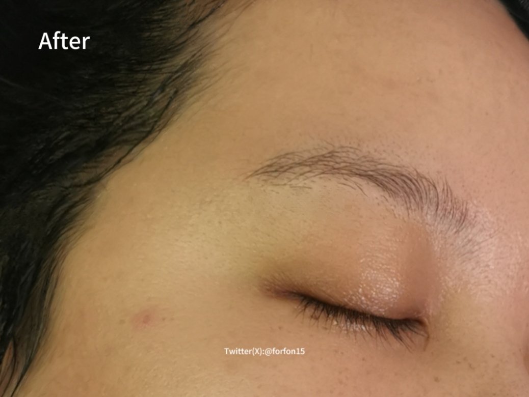 ครีมอันนี้ควรมีทุกบ้านจริงๆ​ นี่โดนยุงกัดหน้าแล้วแพ้น้ำลายยุงไม่ยอมหายอักเสบ​ โบก​ #Cicaplast Baume B5+ +ตัวในตำนานของ​ La​ Roche-Posay​ เป็นสูตร​ Microbiome ช่วยปรับสมดุลแบคทีเรียบนผิว​ ลดอาการอักเสบ ซ่อมแซมผิวได้ดีขึ้น​ เกิดแผลเป็นน้อยลง​

นี่ทาเช้า-เย็น ​อาทิตย์​นึงได้