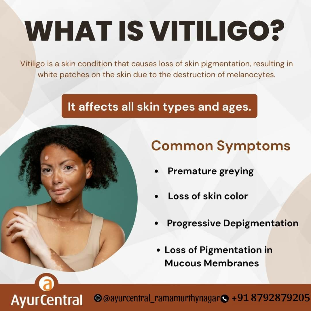 How much do you really know about vitiligo? 🤔.
.
.
.
.
.
#VitiligoWarrior #EmbraceYourSpots #SkinDiversity #BeautyBeyondColor #VitiligoAwareness #ayurvedaeveryday #ayurvedamedicine #ayurvedatips #ayurcentralramamurthynagar #ayurcentralBTMlayout #ayurcentralonline #ayurvedaonline