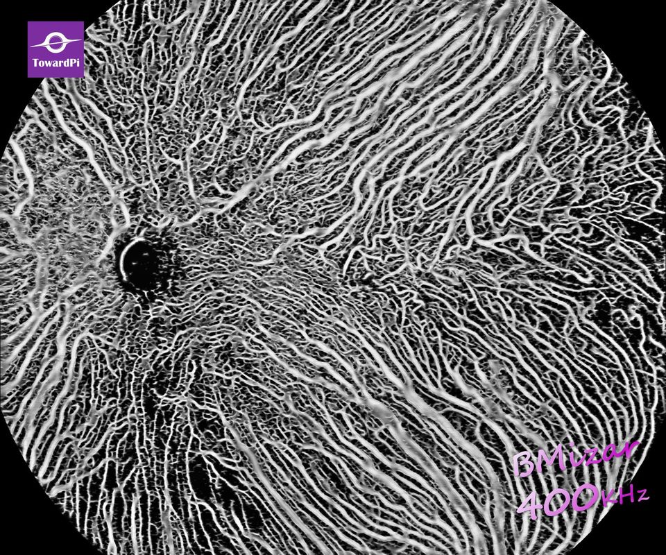 toward_pi's tweet photo. TowardPi's new OCTA algorithms for choroid flow. ๐ Not only did TowardPi successfully launch the #choroidal medium and large blood vessel #algorithm two years ago, but now further upgraded the technology, which makes images more accurate and vivid! #Ophthalmology #Ophthotwitter https://t.co/0nUJco569d