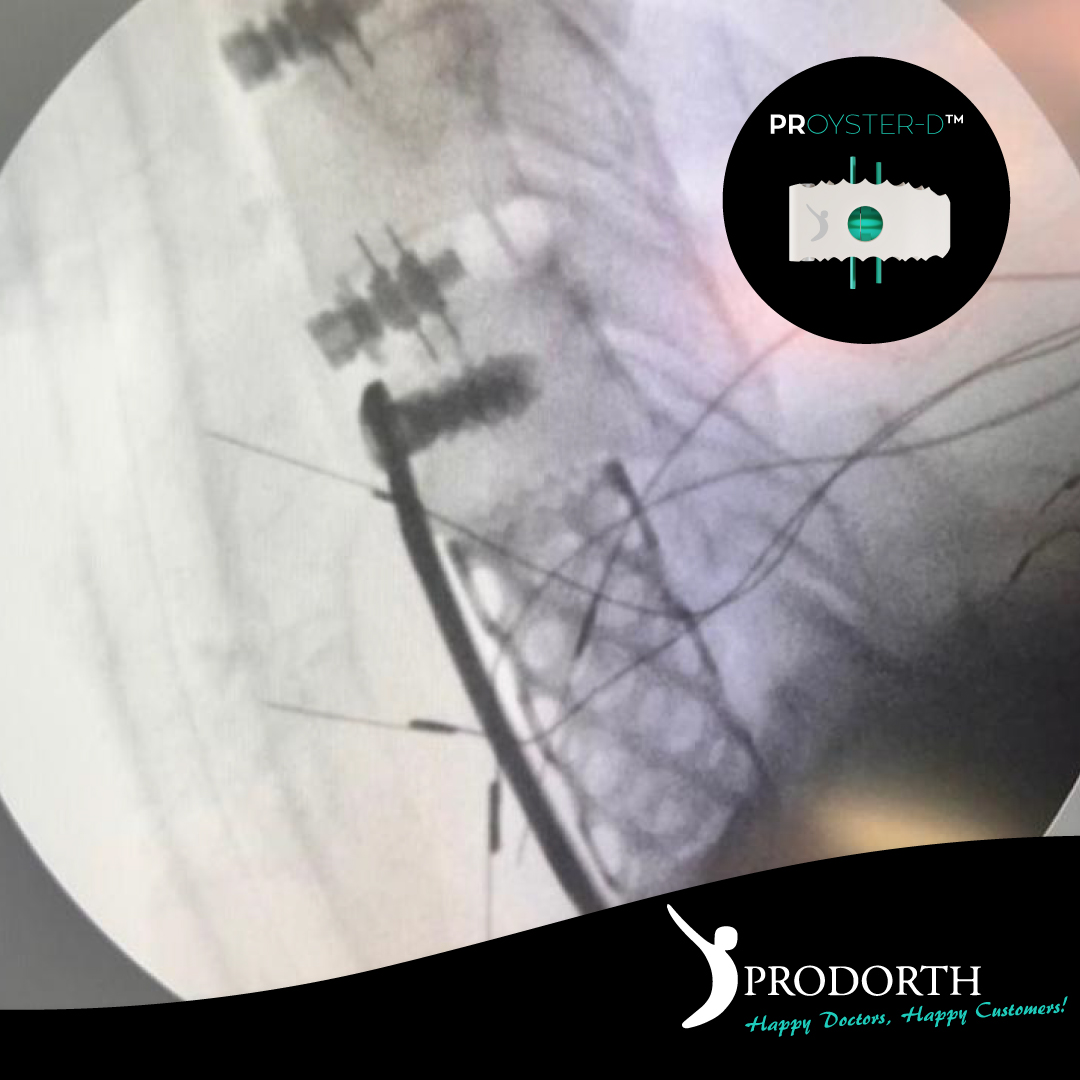 🎯 Anterior Cervical Plate System
PROCTOPUS™️

🎯Anterior Cervical Peek Cages & Bladed
PROYSTER-D™️

📍 Venezuela 🇻🇪

#prodorthspine #spinehealth #spinesurgery #spinedoctor #motionpreservation #spineimplant #spinedevice #cervicalcage #anteriorcervicaldiscectomyandfusion