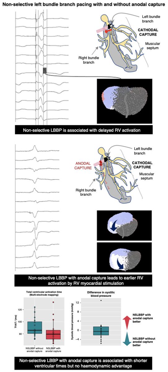 Europace Editor-in-Chief (@europaceeic) on Twitter photo Physiological pacing 🚨
Anodal capture during #LBBAP #LBBP
👉 Advances RV activation
but
👉 Requires higher outputs
👉 No improvement in acute haemodynamics
📖tinyurl.com/nh9wf657
<a href="/ESC_Journals/">European Society of Cardiology Journals</a> #EUROPACE
<a href="/GiulioConte9/">Giulio Conte</a> <a href="/Dominik_Linz/">Dominik Linz</a> <a href="/FraSantoroMD/">Francesco Santoro, MD, PhD</a> <a href="/AndyZhangMD/">Xiaodong Zhang (Andy), MD, PhD, FHRS, FACC</a> <a href="/marcovitoloMD/">Marco Vitolo Ⓜ️</a> Physiological pacing 🚨
Anodal capture during #LBBAP #LBBP
👉 Advances RV activation
but
👉 Requires higher outputs
👉 No improvement in acute haemodynamics
📖tinyurl.com/nh9wf657
<a href="/ESC_Journals/">European Society of Cardiology Journals</a> #EUROPACE
<a href="/GiulioConte9/">Giulio Conte</a> <a href="/Dominik_Linz/">Dominik Linz</a> <a href="/FraSantoroMD/">Francesco Santoro, MD, PhD</a> <a href="/AndyZhangMD/">Xiaodong Zhang (Andy), MD, PhD, FHRS, FACC</a> <a href="/marcovitoloMD/">Marco Vitolo Ⓜ️</a>