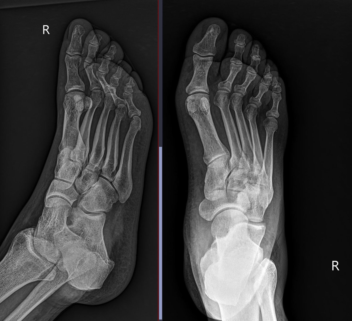 themskarchive's tweet photo. 13/10/2023. Physical examination: Sesamoiditis. X-ray findings: Bipartite tibial sesamoid bone. Ultrasound-doppler findings: degenerative changes in the synchondrosis and perisesamoid hyperemia - inflammation. #forefoot #pain #sesamoiditis #XRAY #ultrasound #doppler https://t.co/vKsCyVBT88