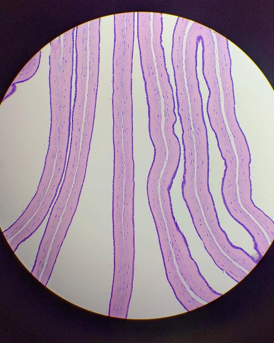 hcabrandonpath's tweet photo. Insane in the membrane 🔬

1. Amnion on each surface and no visible chorion…it’s a "diamnionic-monochorionic" twin placenta.

2. Amnion on each surface and two chorions in the center…it’s a "diamnionic-dichorionic" twin placenta.

#pathology 
#twin
#medicine 
#histology https://t.co/i7xaO6Bkhc