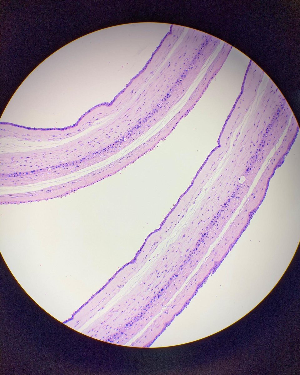 hcabrandonpath's tweet photo. Insane in the membrane 🔬

1. Amnion on each surface and no visible chorion…it’s a "diamnionic-monochorionic" twin placenta.

2. Amnion on each surface and two chorions in the center…it’s a "diamnionic-dichorionic" twin placenta.

#pathology 
#twin
#medicine 
#histology https://t.co/i7xaO6Bkhc