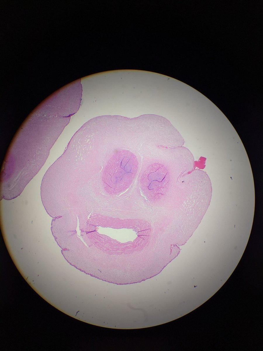 hcabrandonpath's tweet photo. We love a complete cross section of a trivascular umbilical cord with 2 ARTERIES and 1 VEIN 

#mondayfeels 
#pathology 
#recidency 
#medicine
#umbilicalcord https://t.co/V7Mr7zieiA