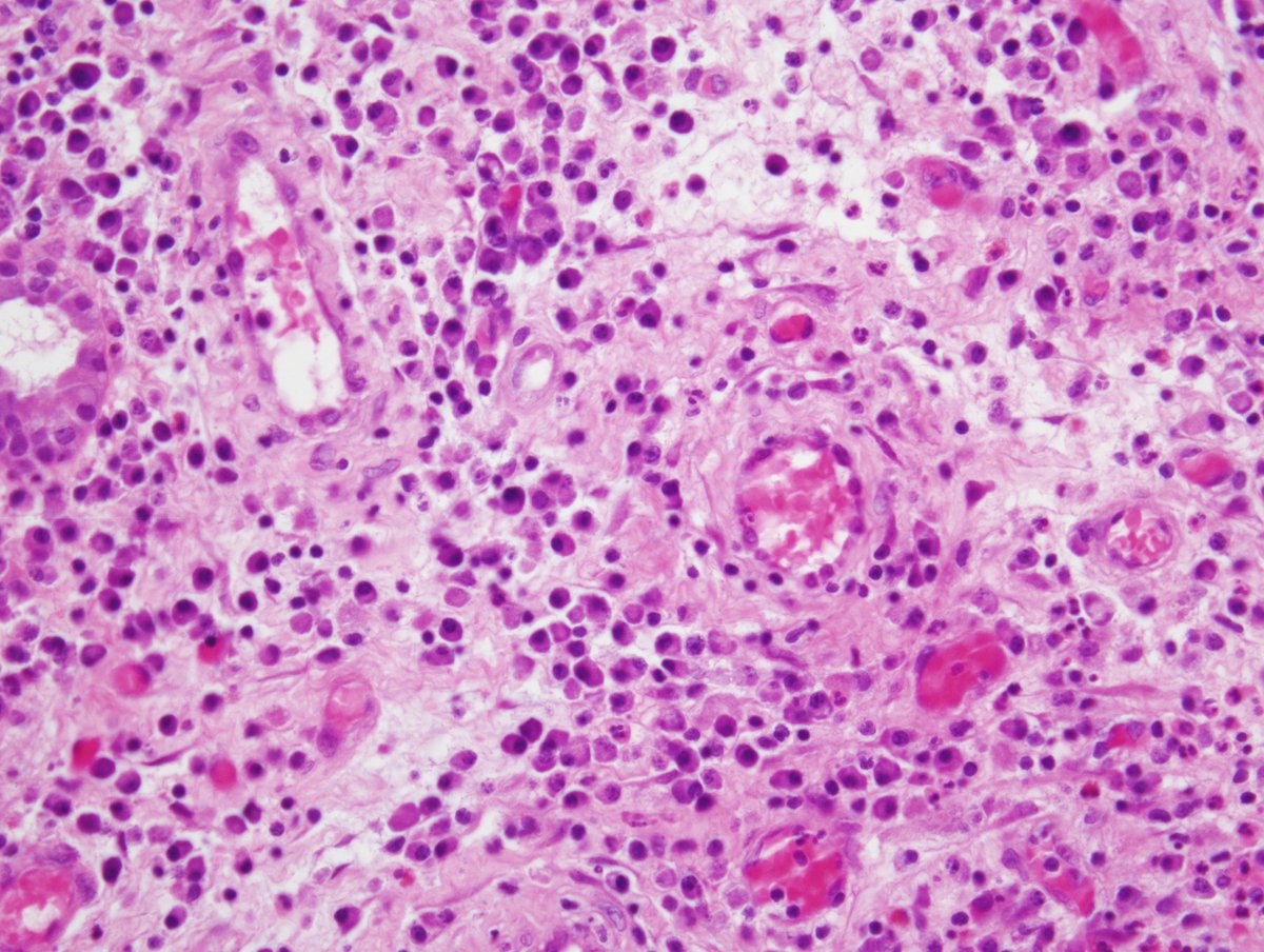 Eosinophilic angiocentric fibrosis is a rare fibro-inflammatory disorder previously of unknown etiology. Now it belongs in IgG4 spectrum of diseases. #surgpath #pathtwitter #pathology #pathologists #ENT