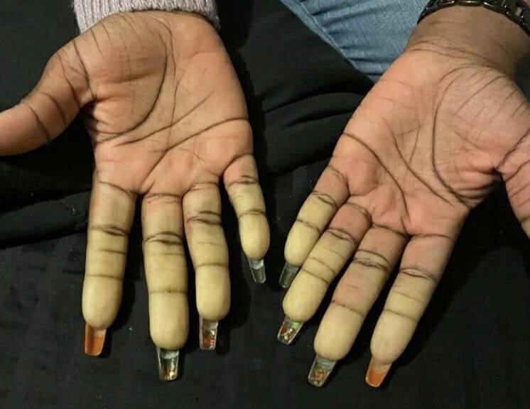 Raynaud’s, a common outcome of a Covid infection, as it can appear on Black people, as there are no pictures in the quoted article. For more info on disease presentation on darker skin see @BrwnSkinMatters