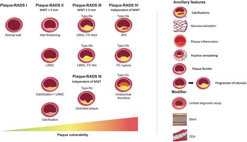CAROTID-RADS: The clearer the communication between all of the involved, the better will be the outcome for our patients! ⭐️
Congrats <a href="/lucasabaITA/">Luca Saba</a> et al !

#neurorad #stroke #neurology