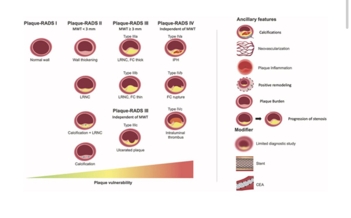 Carotid Plaque RADS! jacc.org/doi/10.1016/j.… super happy to see published this new paper and lexicon !!