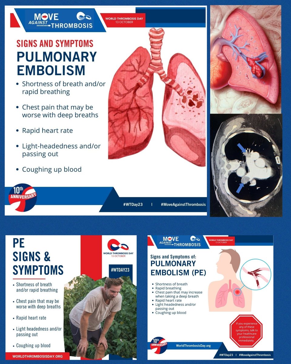 A pulmonary embolism #PE is when a blood vessel in your lungs is blocked by a blood clot. Getting treatment quickly can save your life. Symptoms of a pulmonary embolism include chest pain, difficulty breathing, Wheezing &amp; coughing up blood #WTDay23 #MoveAgainstthrombosis