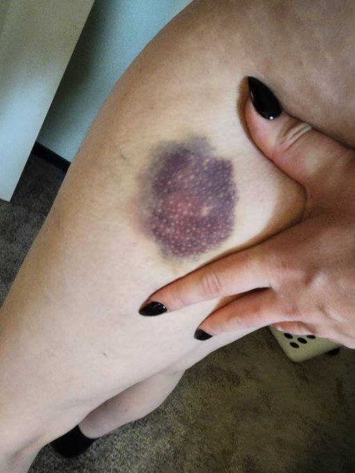 I fell off the bed. 😭 https://t.co/cbbLxBuFib<a href="/tag/judging"class="tags"><span>#judging</span></a><a href="/tag/puppy"class="tags"><span>#puppy</span></a><a href="/tag/feet"class="tags"><span>#feet</span></a><a href="/tag/foot"class="tags"><span>#foot</span></a><a href="/tag/shiba"class="tags"><span>#shiba</span></a><a href="/tag/shibainu"class="tags"><span>#shibainu</span></a><a href="/tag/payed"class="tags"><span>#payed</span></a>