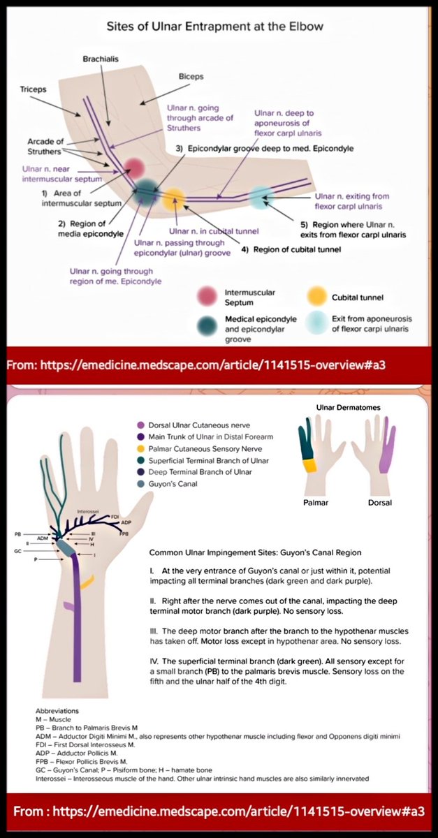 OBandarchi's tweet photo. ULNAR NEUROPATHY made simple: 
Perfect👍From emedicine.medscape: 
https://t.co/bly0XUnJ1R

The most common site of ulnar nerve entrapment is at or near elbow region,esp,in the region of cubital tunnel or ... The second most likely site is at or near the wrist, esp, Guyon’s canal. https://t.co/Kpu4PHahEH