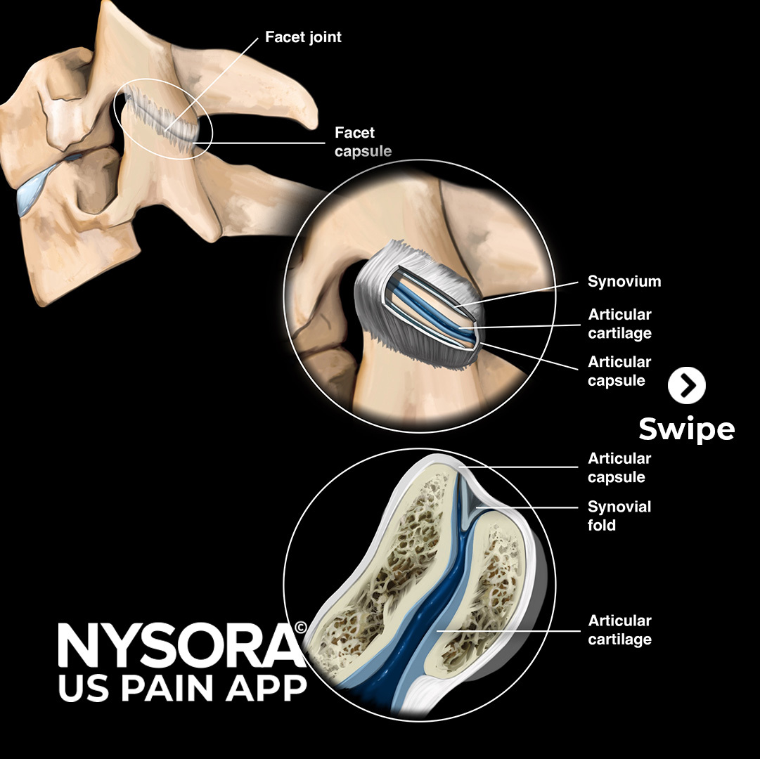 NYSORA's tweet image. 15 Brand New Illustrations have been added to NYSORA&apos;s US Pain App! 🎨

Experience it first-hand and test drive for free: nysora.com/nysora-us-app

#NYSORA #USPainApp #UpdateAlert #MedicalIllustrations
