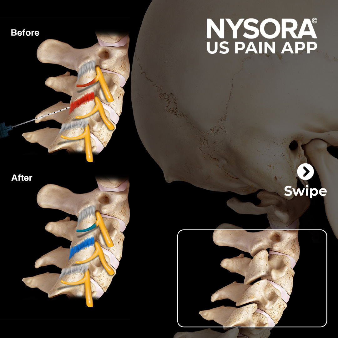 NYSORA's tweet image. 15 Brand New Illustrations have been added to NYSORA&apos;s US Pain App! 🎨

Experience it first-hand and test drive for free: nysora.com/nysora-us-app

#NYSORA #USPainApp #UpdateAlert #MedicalIllustrations