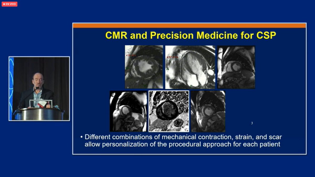 MargaridaPujol's tweet photo. @VTSymposium Personalize CRT @KennethEllenbo1
The role of CMR #Leftbundlebranchpacing
"To provide the best resynchronization to each patient" Dr P. Vijayaraman.
🖤🤍 https://t.co/qioFb7GmVM