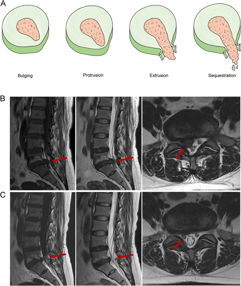SaulNutri's tweet photo. 🤔¿SE PUEDE REABSORBER UNA HERNIA DISCAL?

✅Sí. Y en un porcentaje significativo de los casos resolviéndose los síntomas. Te cuento los mecanismos.

Dentro hilo👇.🧵 https://t.co/Du5oRFuIcD