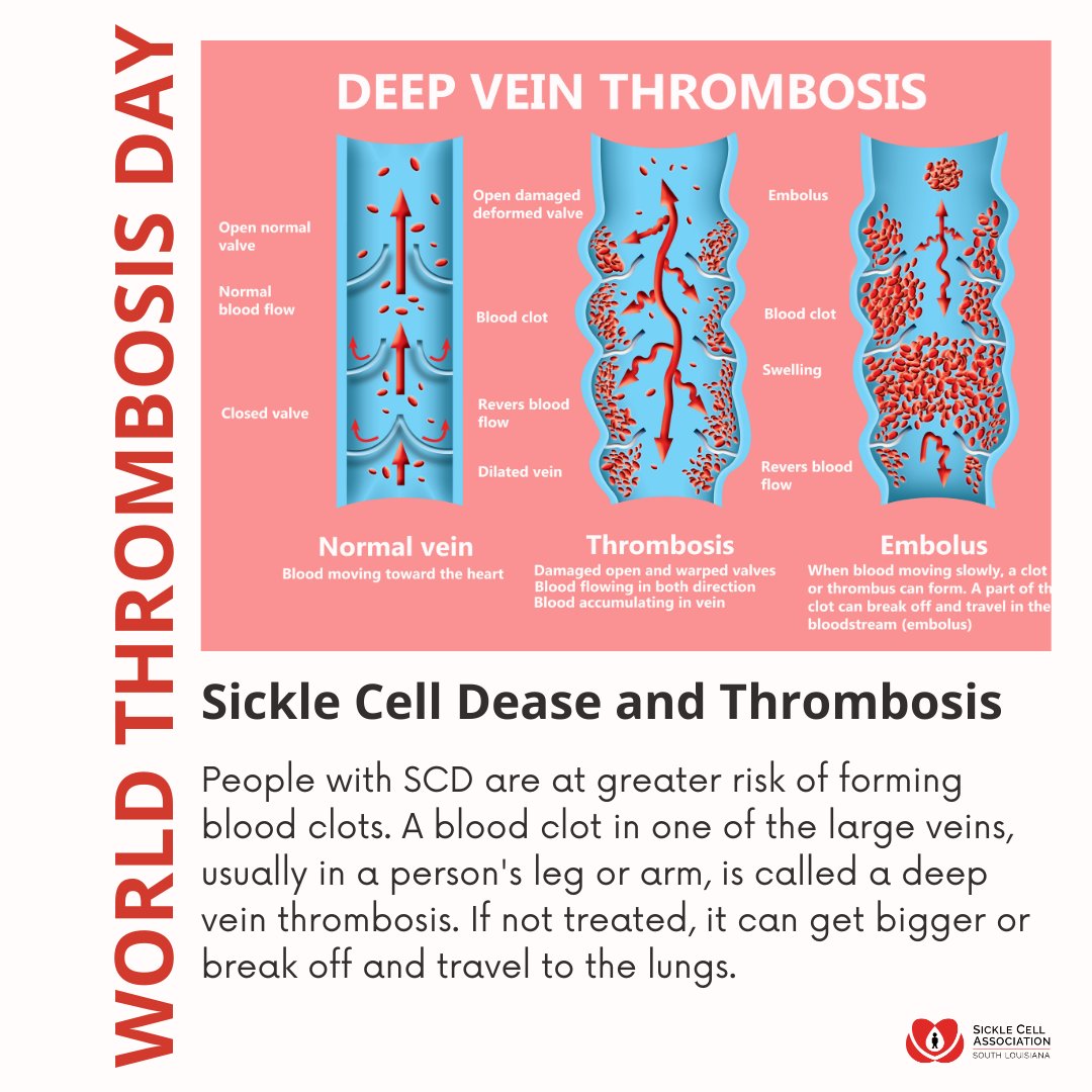 Today is World Thrombosis Day. Thrombosis is a blood clot within blood vessels that limits blood flow. People with SCD are at greater risk of forming blood clots. A blood clot in one of the large veins is called a deep vein thrombosis. 

#SickleCellWarriors #SickleCellDisease