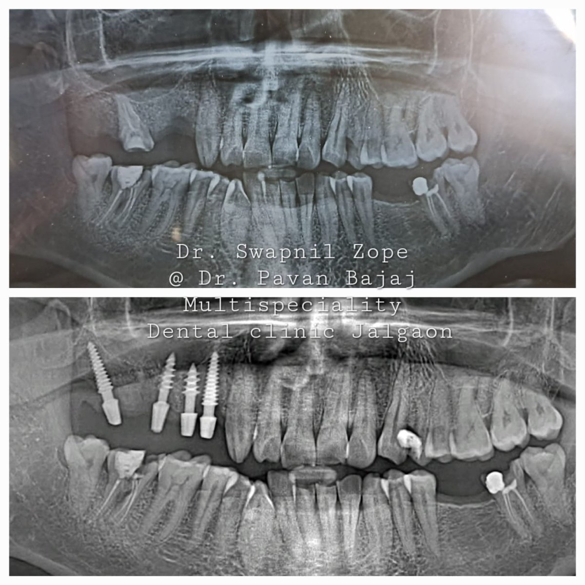 'Smile Restoration Adventures: Dental Implants Triumph Over OSMF with Limited Mouth Opening!' 

#SmileRestoration #DentalImplants #OSMF #OralHealth #HealthySmile #JawLockChallenge #OralSurgery #MouthOpening #OralRehabilitation #DentalCare #PatientSuccess