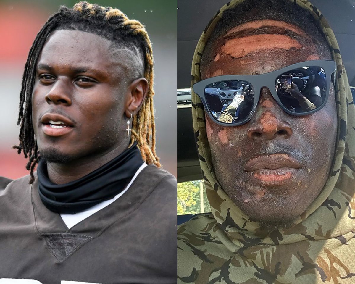 This is awesome: #Browns TE David Njoku says that he decided to show his burns on social media because other burn victims were reaching out to him talking about how they are embarrassed to show their face because of their appearance due to the burns.

He showed his face to make