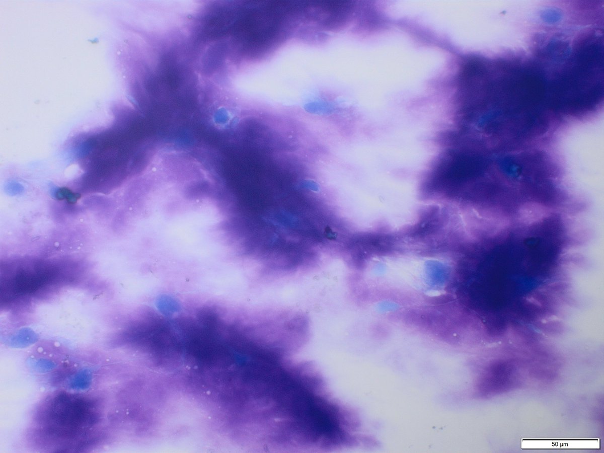 CollinLaetitia2's tweet photo. Look at these #peroperative #cytologic smears and histological control of a parotid gland nodule suspicious on MRI.  A preoperative #FNA could have avoided a surgical procedure in a young 35 years old woman. https://t.co/Nh82lAAEeE