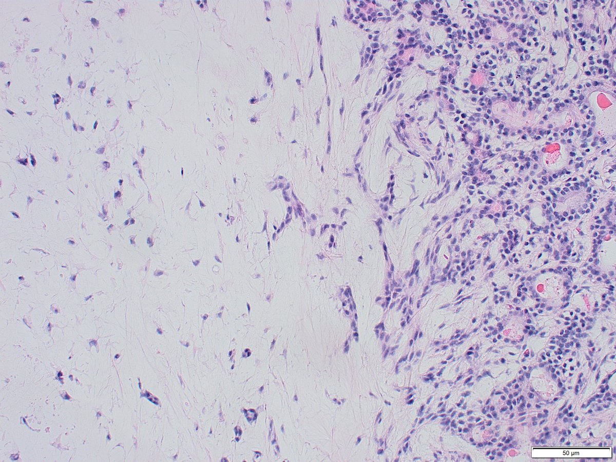 CollinLaetitia2's tweet photo. Look at these #peroperative #cytologic smears and histological control of a parotid gland nodule suspicious on MRI.  A preoperative #FNA could have avoided a surgical procedure in a young 35 years old woman. https://t.co/Nh82lAAEeE