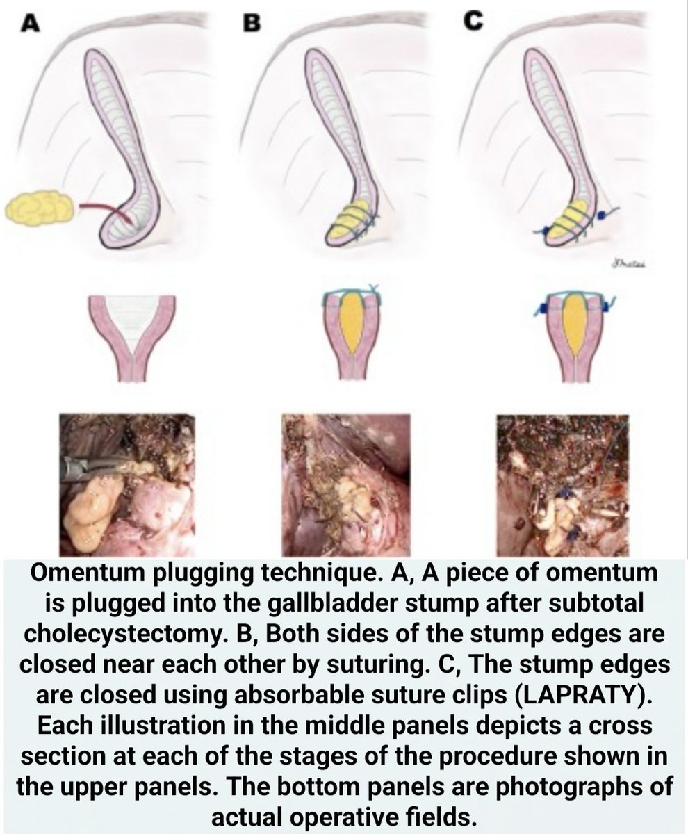 DRAFTABAHMED7's tweet photo. Use of a piece of free omentum to prevent bile leakage after subtotal cholecystectomy (omentum plugging technique OPT):⏬
 See pic below for Text ⏬⏬
#hepatobiliary 
#cholecystectomy
#laparoscopic
#bileduct #omentum
#biloma https://t.co/efmo5h9XUI